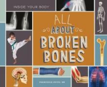 Cover image of All about broken bones